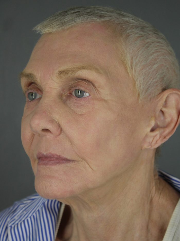 Case--8651 | After Lip Lift 2