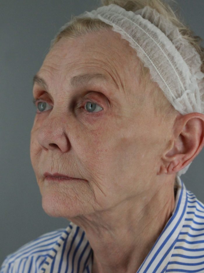 Case--8651 | Before Lip Lift 2