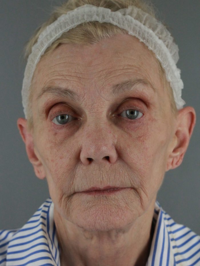 Case--8651 | Before Lip Lift