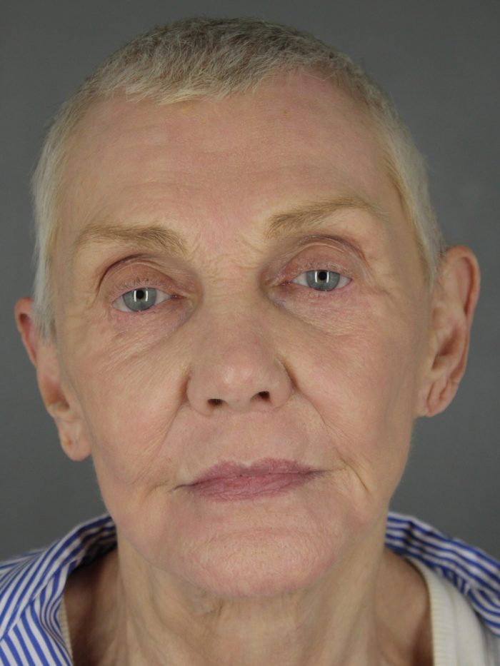 Case--8651 | After Lip Lift