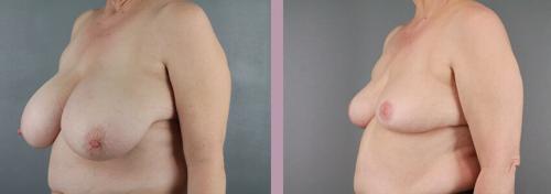 client 24 Breast Reduction, Scottsdale Plastic Surgeon